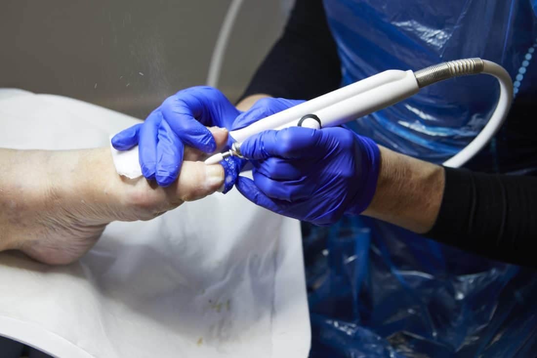 Podiatrist using drill to reduce nail thickness