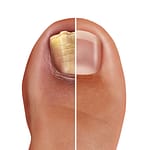Fungal Nail