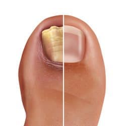 Fungal Nail