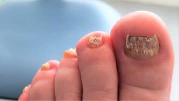 fungal Nail Infection