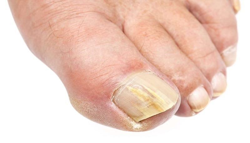 toenail-fungus