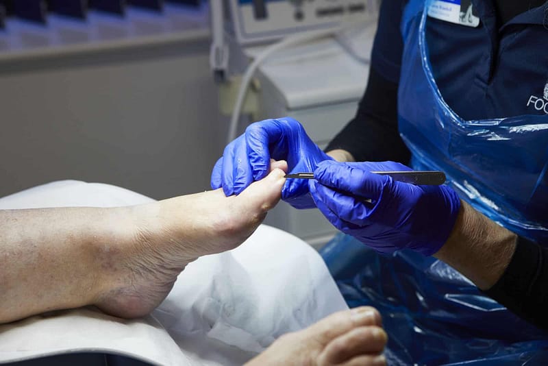 Podiatrist wearing blue performing a toenail treatment